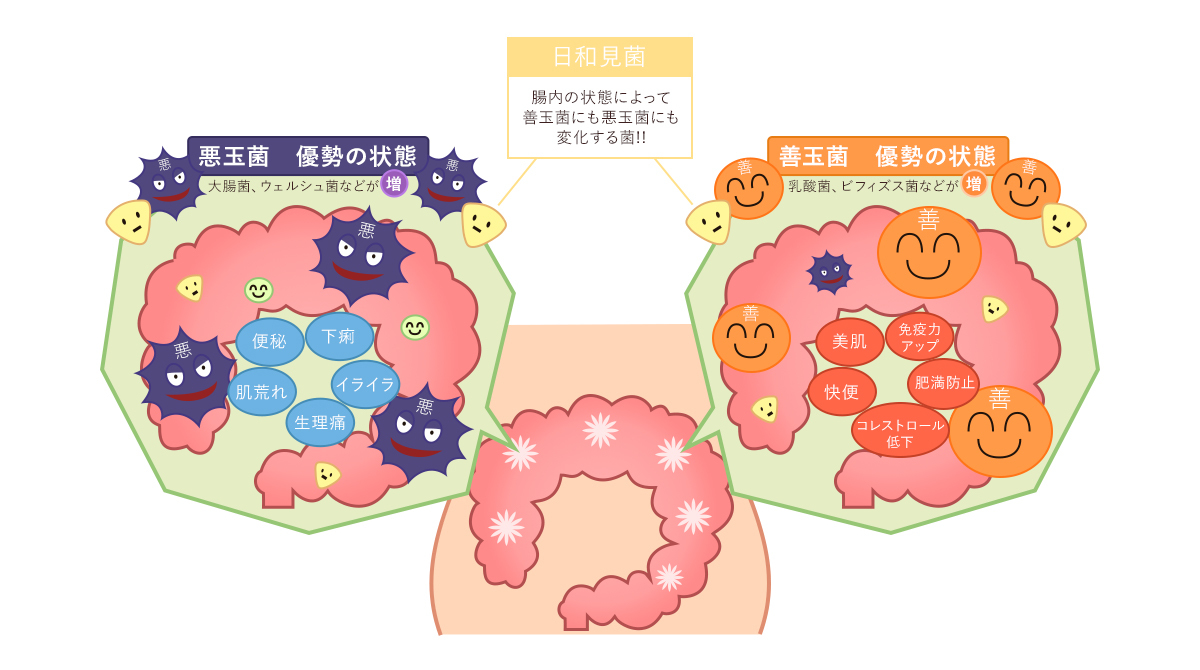 腸内の悪玉菌優勢の状態と善玉菌優勢の状態の比較
